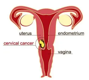 What is cervical cancer