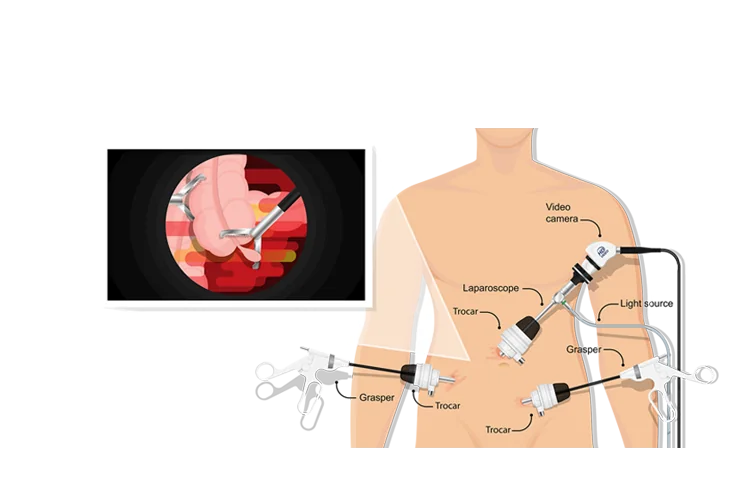 How laparoscopic surgery works: camera, trocars and instruments through small cuts