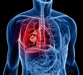 Lung Cancer