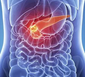 Pancreatic Cancer
