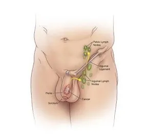 Penile Cancer