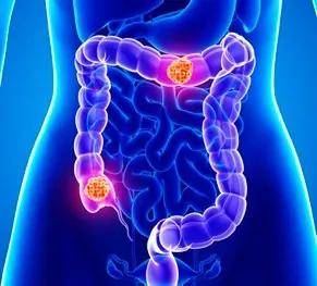 Rectal cancer